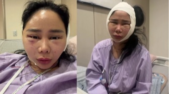 Denise Chariesta Operasi Plastik di Wajah, Klaim Habiskan Rp1 Miliar