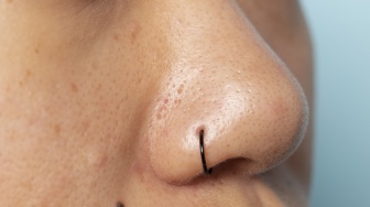 Apa Itu Segitiga Kematian di Wajah? Viral Kisah Suami Meninggal Usai Istri Iseng Pencet Jerawatnya