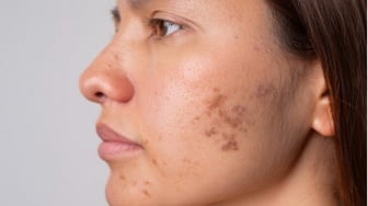 5 Produk Viva Cosmetics yang Ampuh Atasi Flek Hitam, Harga di Bawah Rp50 Ribu