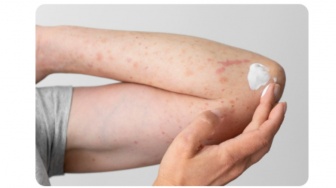 Beda Ruam Campak dan Cacar, Kenali 5 Perbedaan Pola hingga Cara Penularannya