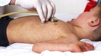 Waspada! 5 Gejala Awal Campak pada Bayi yang Sering Dikira Cuma Flu Biasa