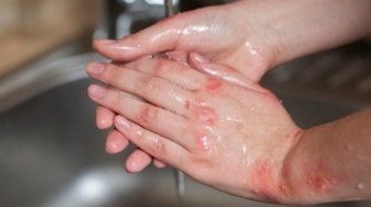 4 Langkah Pertolongan Pertama Jika Kena Air Keras, Antisipasi dari Kasus Andrie Yunus