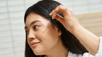 Wajah Muncul Jerawat setelah Lebaran! Ini 4 Acne Serum yang Layak Dicoba