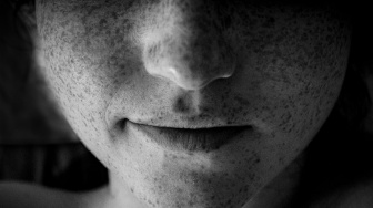 5 Vitamin Terbaik untuk Menghilangkan Flek Hitam di Wajah