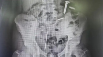 Misteri di Balik Rontgen: Ada Paku dan Benda Asing dalam Tubuh Pemuda Jember yang Pernah Dirantai