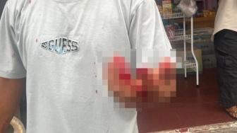 Kasus Jari Putus Digigit di Bukitraya Pekanbaru, Pelaku Belum Ditangkap
