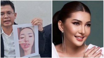 Ingin Cantik, Malah Luka Serius, Korban Dokter Gadungan Eks Finalis Puteri Indonesia Alami Trauma