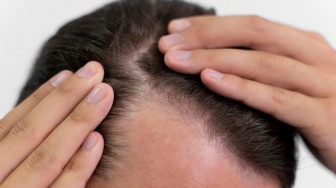 3 Rekomendasi Shampo Terbaik untuk Mengatasi Hairline Mundur: Rambut Tebal, Rontok Berkurang