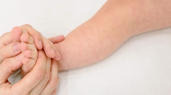 Kasus Dermatitis pada Bayi dan Anak Terus Meningkat, Ini Cara Cegah Eksim Si Kecil Kambuh