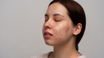 Cushion vs Foundation: Mana yang Lebih Aman dan Ampuh untuk Kulit Berjerawat?
