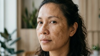 Melasma Tak Sama dengan Flek Biasa, Kenali Pemicunya yang Ternyata Bukan Hanya Sinar Matahari