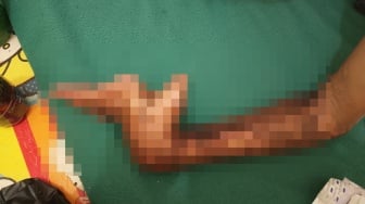 Derita Pekerja asal Jambi, Cacat Permanen Akibat Kecelakaan Kerja di Kampar
