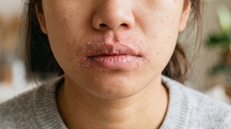 Apa Penyebab Kulit Kering di Sekitar Mulut? Begini Cara Mengatasinya