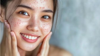 Bebas Jerawat! 5 Acne Spot Treatment Korea yang Bikin Jerawat Cepat Kering