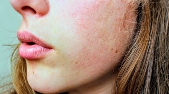 3 Manfaat Tranexamic Acid untuk Melasma dan Flek Hitam, Benar Efektif?