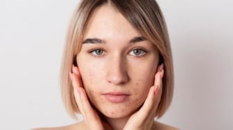 Wajah Auto Mulus! 5 Dark Spot Correcting Serum Ampuh Samarkan Noda Hitam