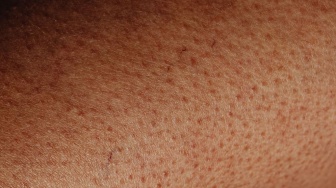 Apa Beda Strawberry Skin dan Chicken Skin? Ini Penyebab serta Cara Mengatasinya