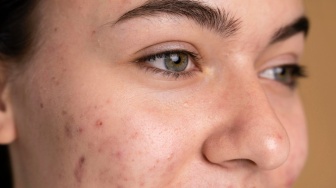 6 Cara Memakai Sunscreen pada Wajah Berjerawat Meradang Tanpa Memicu Komedo