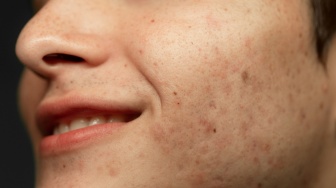 5 Rekomendasi Sunscreen Khusus Kulit Berflek Hitam No Whitecast, Cegah Noda Makin Gelap