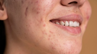 Manfaat Azelaic Acid untuk Memudarkan PIE, PIH dan Meredakan Rosacea di Usia 30+