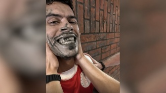 Kondisi Korban Serangan Brutal Eks Timnas Indonesia Jhon van Beukering: Tujuh Gigi Copot