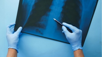 Mengapa Pasien Kanker Bisa Dapat Pengobatan Berbeda Meski Diagnosisnya Sama? Ini Penjelasannya