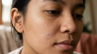 Acne Patch Dipakai Berapa Lama? Ini Cara Kerja dan Durasi Penggunaannya