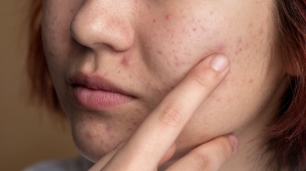 Perbedaan Chemical, Physical, dan Hybrid Sunscreen: Mana yang Paling Cocok untuk Jerawat?