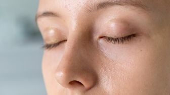 Apakah Viva Retinol Serum Bisa Menghilangkan Milia? Ini Efeknya pada Wajah
