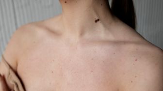 Bagaimana Cara Menghilangkan Flek Hitam di Leher dan Dada Akibat Paparan Matahari?
