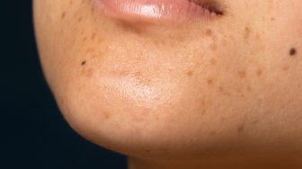 Perbedaan Melasma, Lentigo, dan Hiperpigmentasi Bekas Jerawat pada Kulit: Kenali Ciri-cirinya