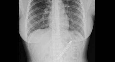 Ini Beragam Benda Yang Pernah Ditemui Dokter Di Dalam Anus Pasien