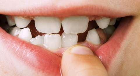 Tak Perlu Ke Dokter Ini Cara Mudah Bersihkan Karang Gigi Sendiri