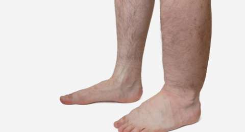 tratament cu 1 grad de artroză a genunchiului inflamația pungii periarticulare a articulației genunchiului
