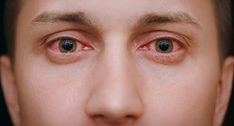 Hasil gambar untuk mata merah perih