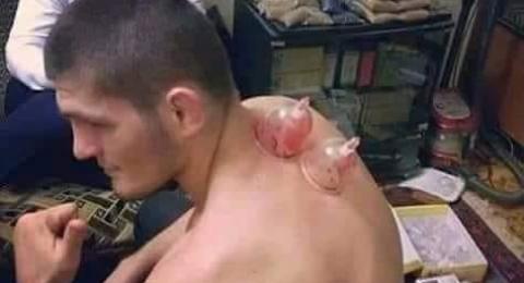 Khabib Saja Suka di Bekam, Ini Manfaat Bekam yang Harus Anda Tahu