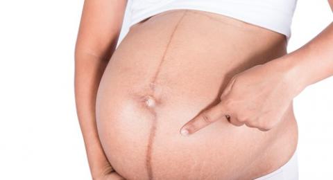 Linea Nigra Pada Ibu Hamil Bisa Prediksi Jenis Kelamin Bayi
