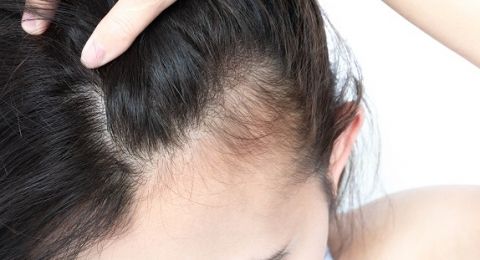 Simak 3 Cara Menghilangkan Kutu Rambut Secara Alami Simak 3 Cara Menghilangkan Kutu Rambut Secara Alami