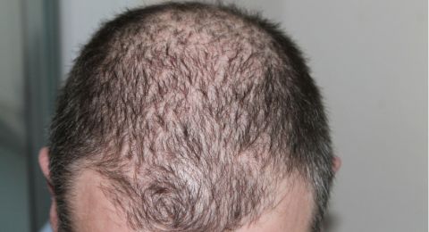 4 Tanaman Herbal yang Ampuh Atasi Rambut Rontok, Salah Satunya Daun Sage