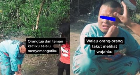 Viral Kisah Bocah Lelaki Alami Luka Bakar Hanya Punya Satu Teman Bermain