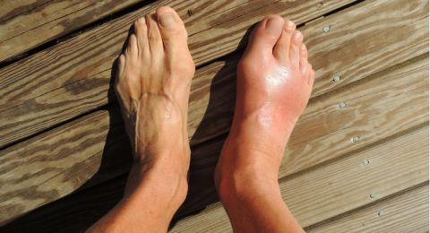 Inilah 3 Herbal yang Dipercaya Ampuh Atasi Asam Urat, Silakan Dicoba!