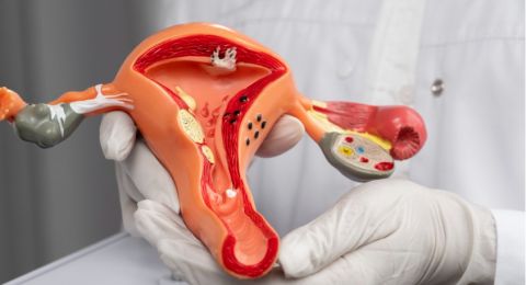 5 Mitos Penyakit Endometriosis yang Dipercaya Wanita, Banyak yang Tertipu!
