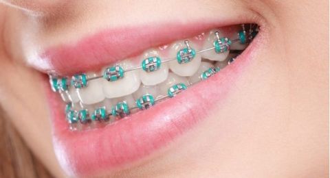 5 Cara Merawat Gigi Menggunakan Behel, Pemula Wajib Tahu!
