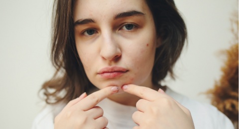 Jangan Asal Pencet! Begini 5 Cara Merawat Jerawat di Wajah