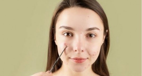 Jerawat Auto Kering! 3 Acne Spot Mengandung Sulfur Harga Mulai Rp5 Ribu