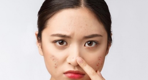 Hempas Jerawat, Ini 3 Rekomendasi Toner Lokal Mengandung Tea Tree