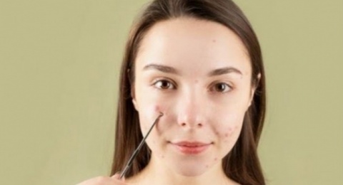 3 Acne Spot Gel Ampuh Meredakan Jerawat Mendem dengan Cepat, Ada Favoritmu?