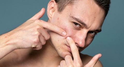 4 Rekomendasi Acne Spot Treatment yang Ampuh Hempas Jerawat Membandel