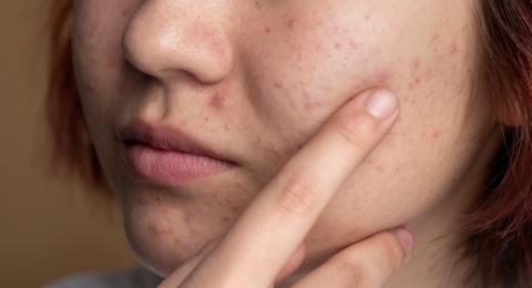 Kulit Cerah Bebas Noda! 5 Dark Spot Serum Terbaik yang Layak Kamu Coba