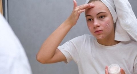 4 Rekomendasi Moisturizer Terbukti Ampuh Mempercepat Penyembuhan Jerawat